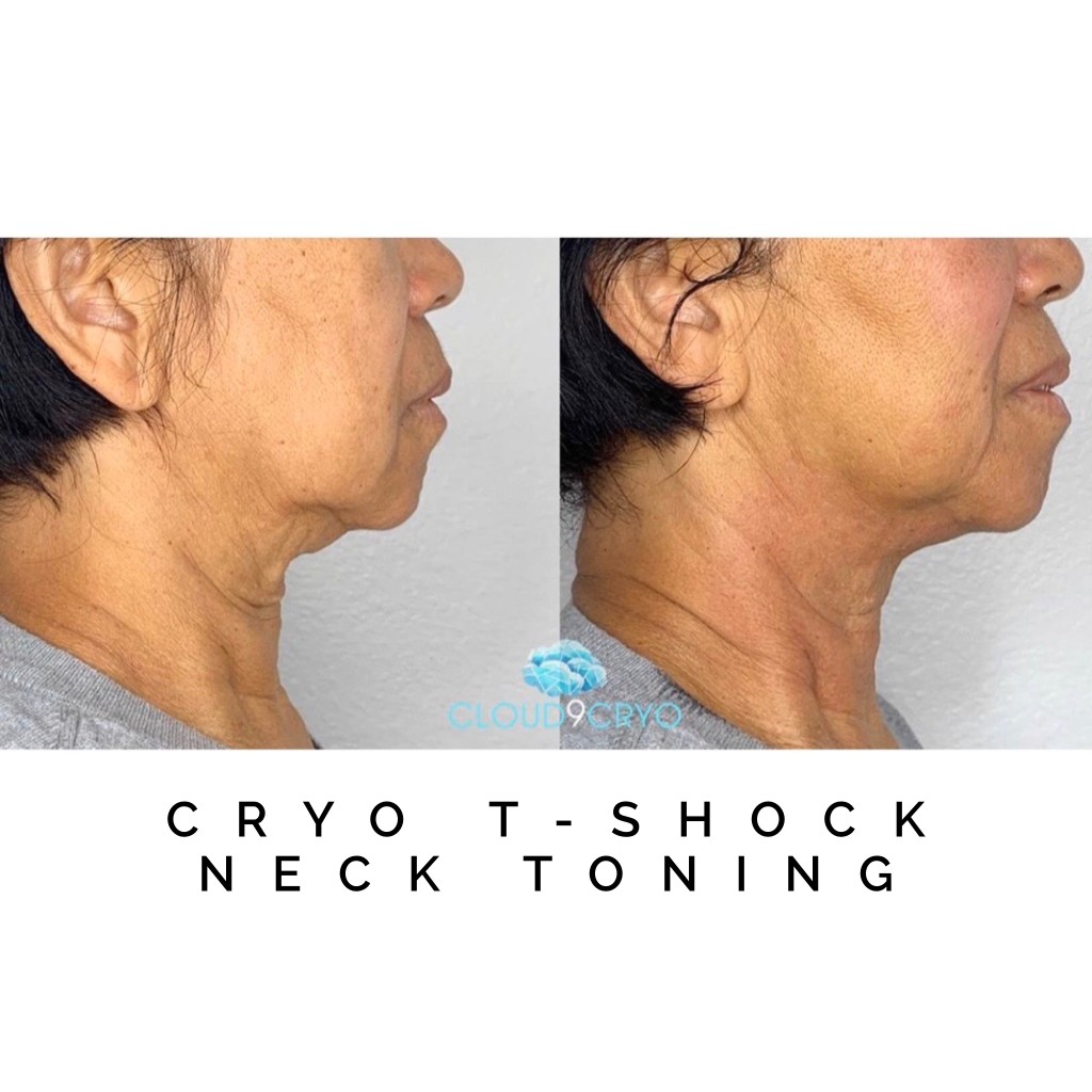 Cryo Toning Before And After